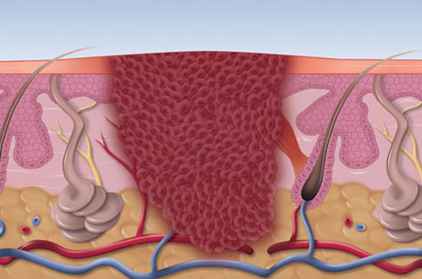 microwave therapy fig1