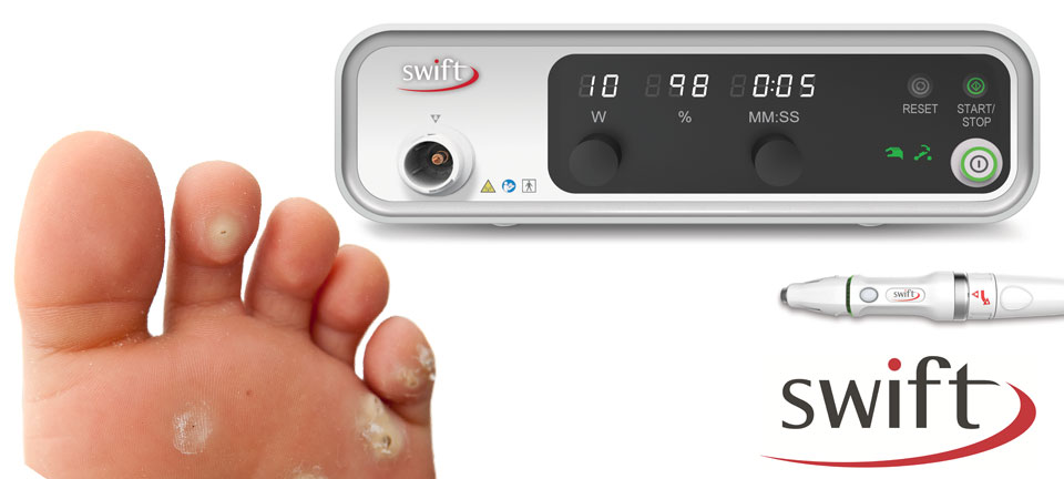 microwave therapy for verrucae