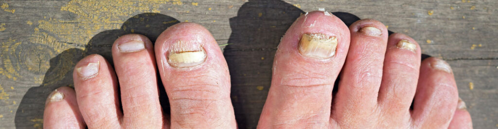 fungal nail infection treatment