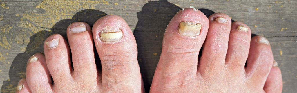 fungal nail infection treatment