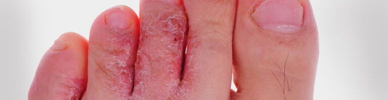 athlete's foot treatment