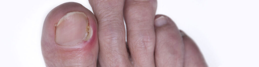 ingrown toenail treatment