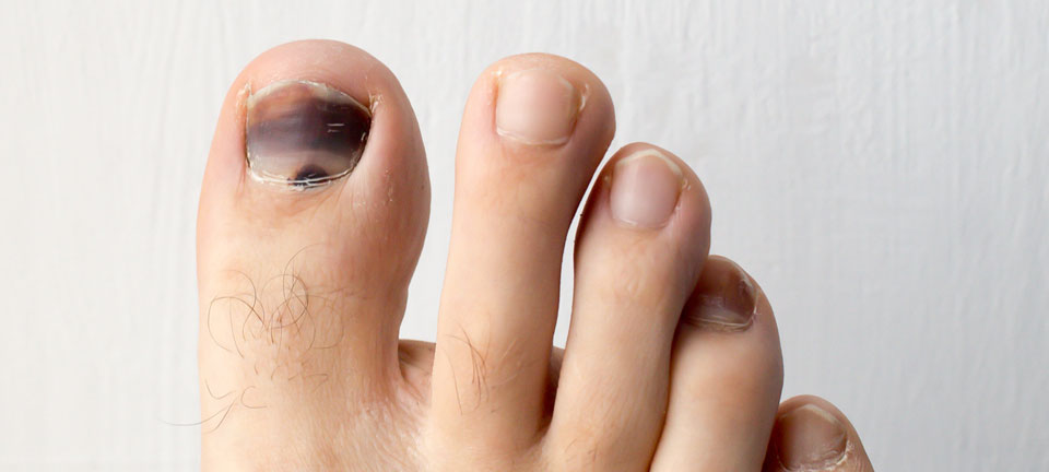 blackened toenail